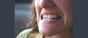 A close-up of he mouth of a woman with crooked teeth.