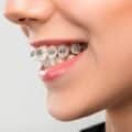 A woman wearing braces to treat her overbite.