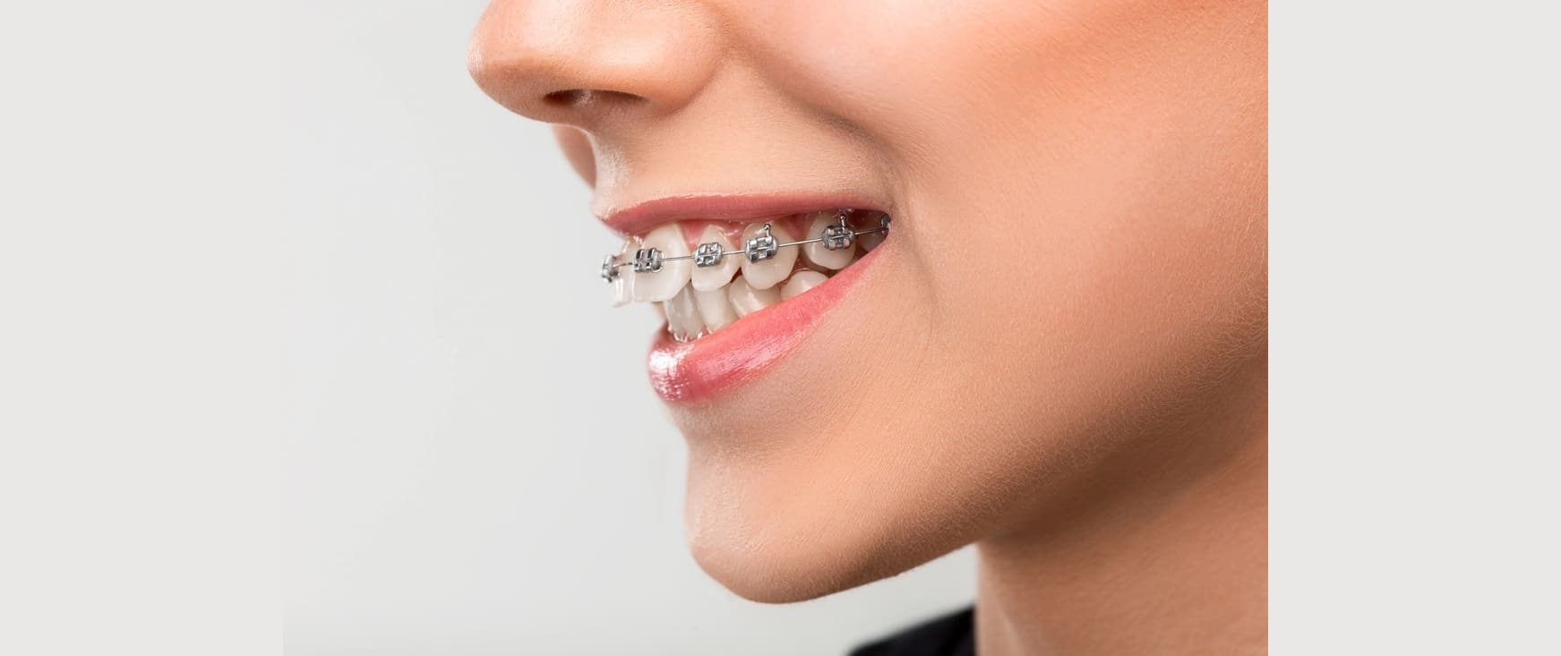 A woman wearing braces to treat her overbite.