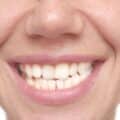 A close-up of the mouth of a woman with crooked teeth.