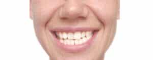 A close-up of the mouth of a woman with crooked teeth.