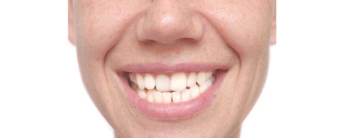 A close-up of the mouth of a woman with crooked teeth.